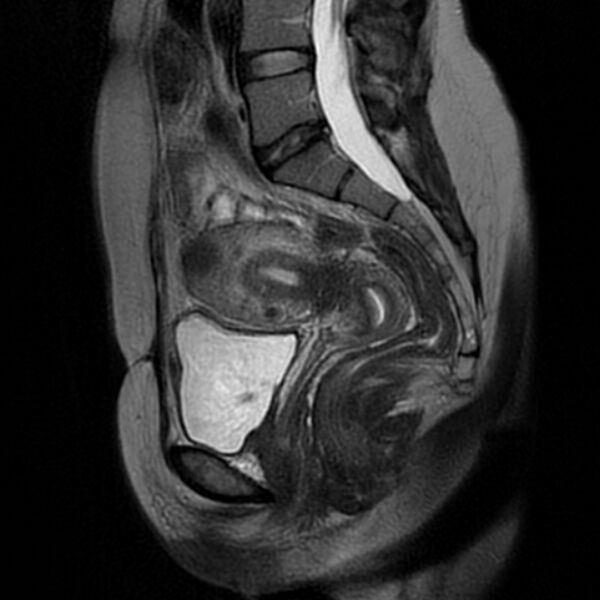 File:Adenomyosis within a septate uterus (Radiopaedia 69963-79981 Sagittal T2 15).jpg