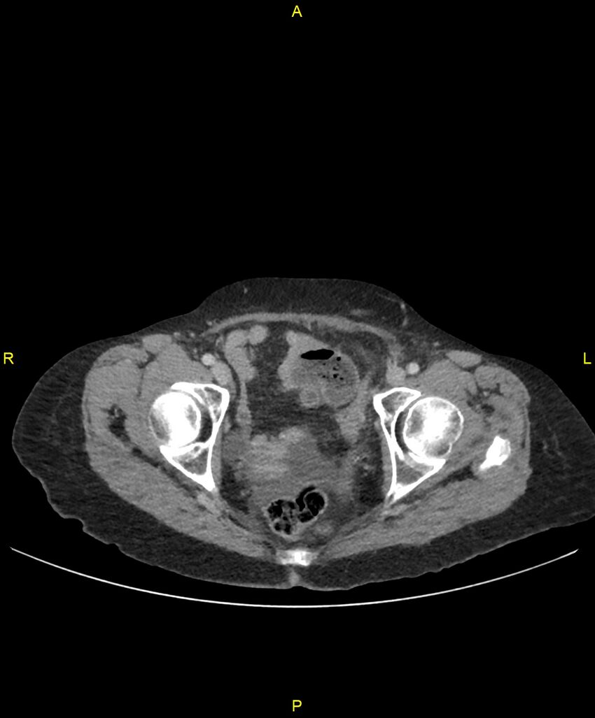 Adhesional small bowel obstruction (Radiopaedia 85402-101024 Axial C+ portal venous phase 265).jpg