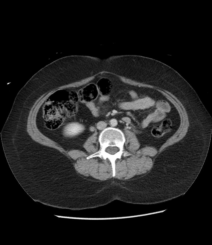 Adrenal cortical carcinoma with IVC invasion and thrombosis (Radiopaedia 34307-35597 Axial C+ portal venous phase 49).jpg