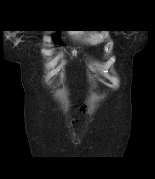 File:Adrenal cortical carcinoma with IVC invasion and thrombosis (Radiopaedia 34307-35597 Coronal C+ portal venous phase 10).jpg
