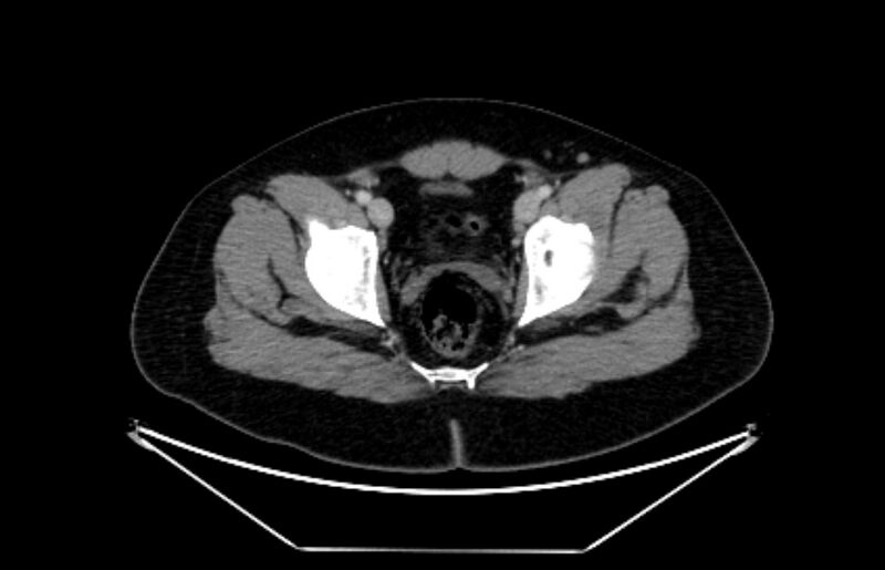 File:Adrenocortical carcinoma (Radiopaedia 80134-93438 Axial C+ portal venous phase 122).jpg