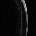 Aggressive vertebral hemangioma (Radiopaedia 39937-42404 Sagittal T2 10).png