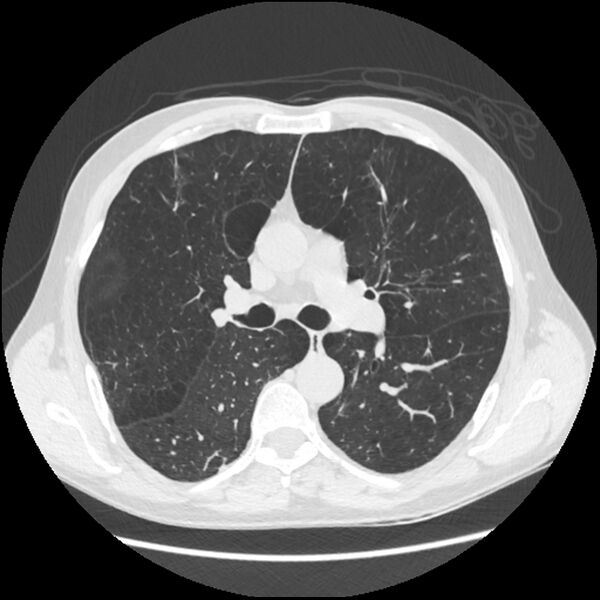 File:Alpha-1-antitrypsin deficiency (Radiopaedia 40993-43722 Axial lung window 101).jpg