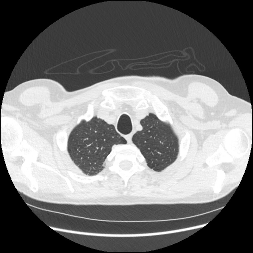 Alpha-1-antitrypsin deficiency (Radiopaedia 40993-43722 Axial lung window 22).jpg