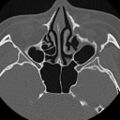 Ameloblastic fibro-odontoma (Radiopaedia 18843-18780 C 2).jpg