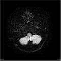 Amnestic syndrome secondary to hypoxic brain injury (Radiopaedia 24743-25004 DWI 6).jpg