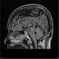 Amnestic syndrome secondary to hypoxic brain injury (Radiopaedia 24743-25004 D 9).jpg