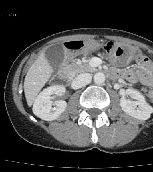 File:Ampulla of Vater metastasis (Radiopaedia 27820-28065 A 28).jpg