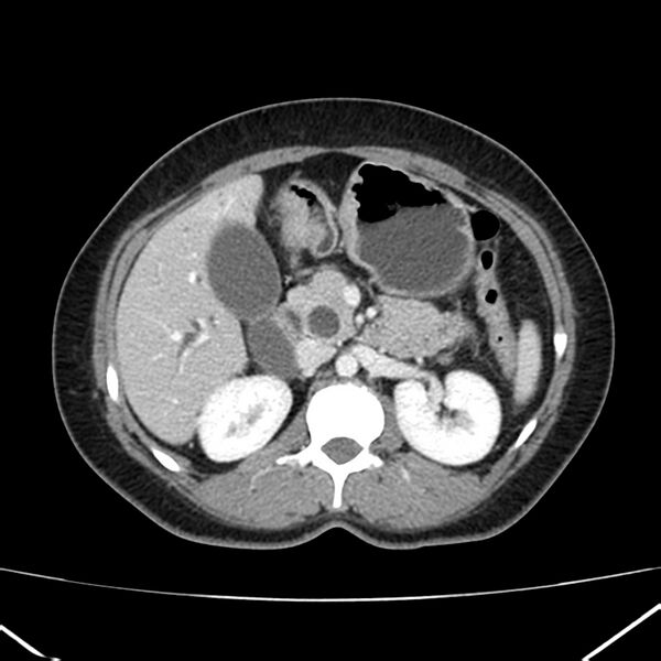 File:Ampullary tumor (Radiopaedia 22787-22816 C 24).jpg