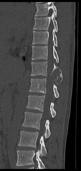 File:Aneurysmal bone cyst T11 (Radiopaedia 29294-29721 Sagittal bone window 35).jpg