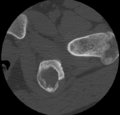 Aneurysmal bone cyst of ischium (Radiopaedia 25957-26094 B 27).png