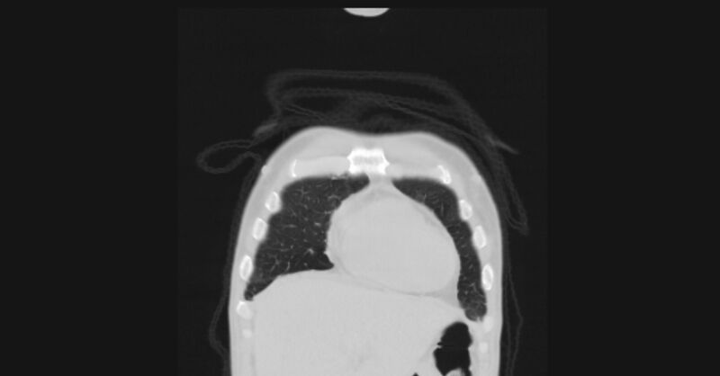 File:Angioinvasive aspergellosis (Radiopaedia 66995-76315 Coronal lung window 6).jpg