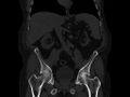Ankylosing spondylitis (Radiopaedia 44609-48357 Coronal bone window 32).jpg