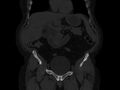 Ankylosing spondylitis (Radiopaedia 44609-48357 Coronal bone window 7).jpg