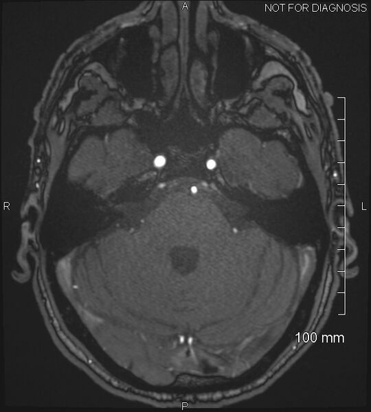 File:Anterior cerebral artery aneurysm (Radiopaedia 80683-94127 Axial MRA 60).jpg