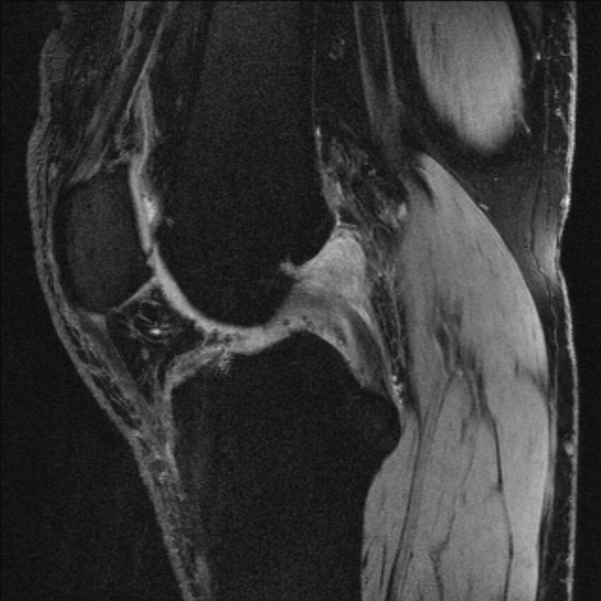 Anterior cruciate ligament mucoid degeneration (Radiopaedia 68400-77933 Sagittal 35).jpg