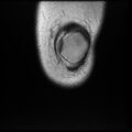 Anterior cruciate ligament tear, Wrisberg rip and bucket-handle tear of medial meniscus (Radiopaedia 75872-87266 Coronal T1 3).jpg