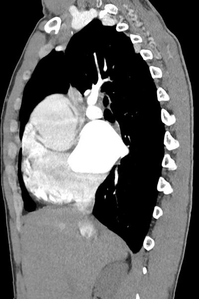 File:Aortic coarctation with aneurysm (Radiopaedia 74818-85828 B 64).jpg