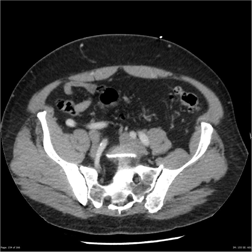 Aortic dissection- Stanford A (Radiopaedia 37759-39664 A 145).jpg