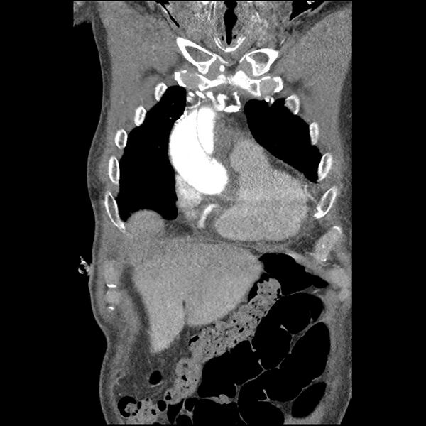 File:Aortic dissection - DeBakey Type I-Stanford A (Radiopaedia 79863-93115 B 9).jpg