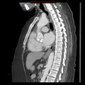 Aortic valve stenosis (Radiopaedia 14480-14423 B 2).jpg