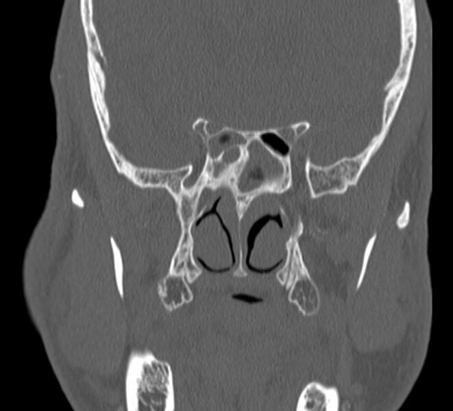 File:Aplastic maxillary sinuses (Radiopaedia 60030-67561 Coronal non-contrast 29).jpg