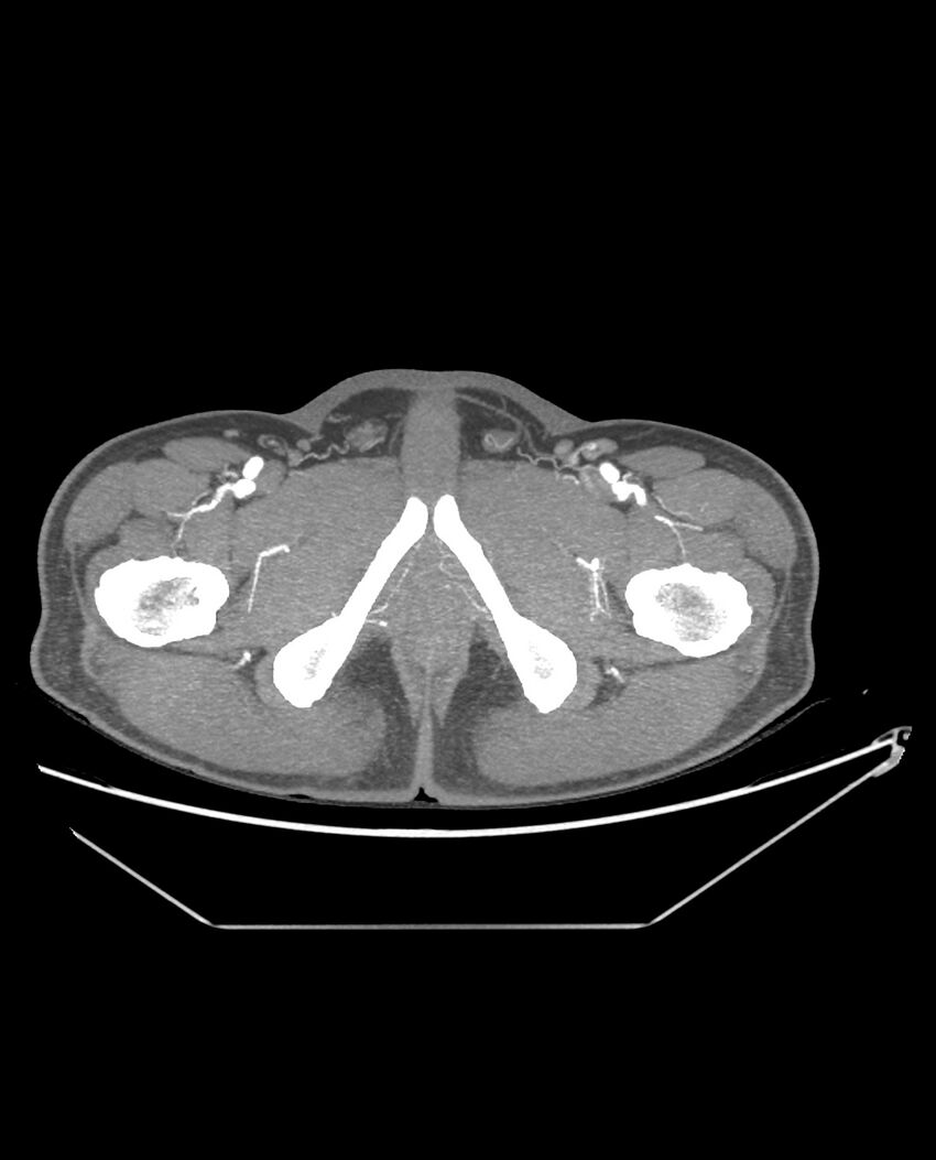 Aplastic posterior tibial arteries (Radiopaedia 84021-99249 A 107).jpg
