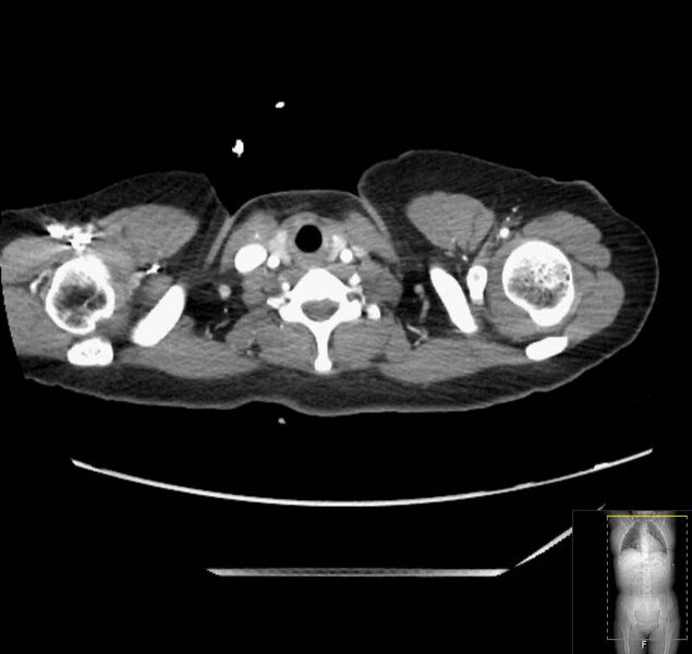 File:Appendicitis (CT angiogram) (Radiopaedia 154713-127660 Axial 248).jpg