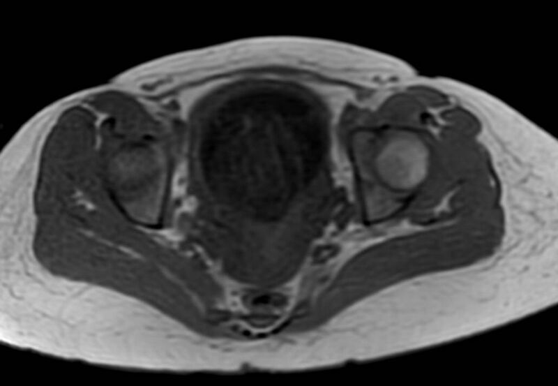 File:Appendicitis in gravida (MRI) (Radiopaedia 89433-106395 Axial T1 in-phase 63).jpg