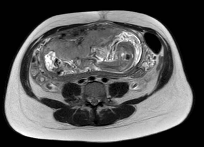File:Appendicitis in gravida (MRI) (Radiopaedia 89433-106395 Axial T2 41).jpg