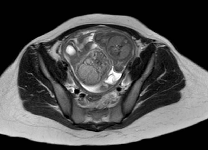 File:Appendicitis in gravida (MRI) (Radiopaedia 89433-106395 Axial T2 56).jpg