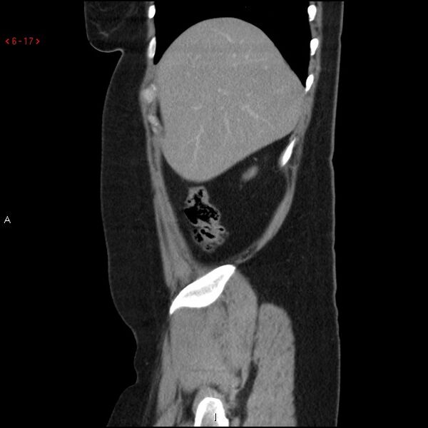 File:Appendicitis with microperforation- promontoric type (Radiopaedia 27268-27442 A 2).jpg