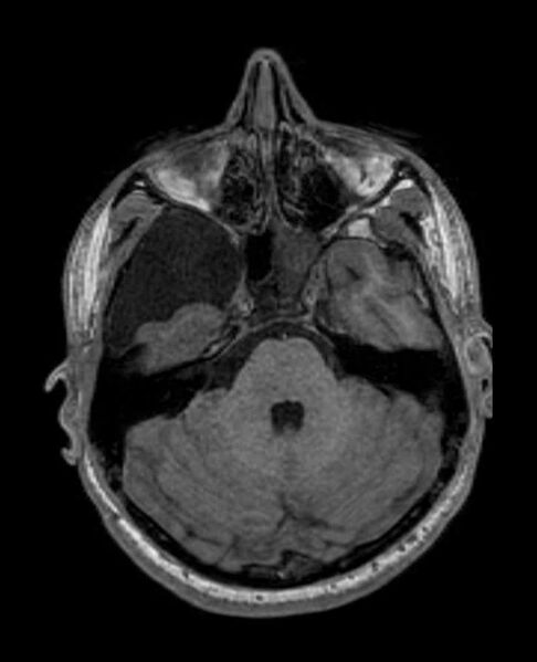 File:Arachnoid cyst- extremely large (Radiopaedia 68741-78451 Axial T1 22).jpg