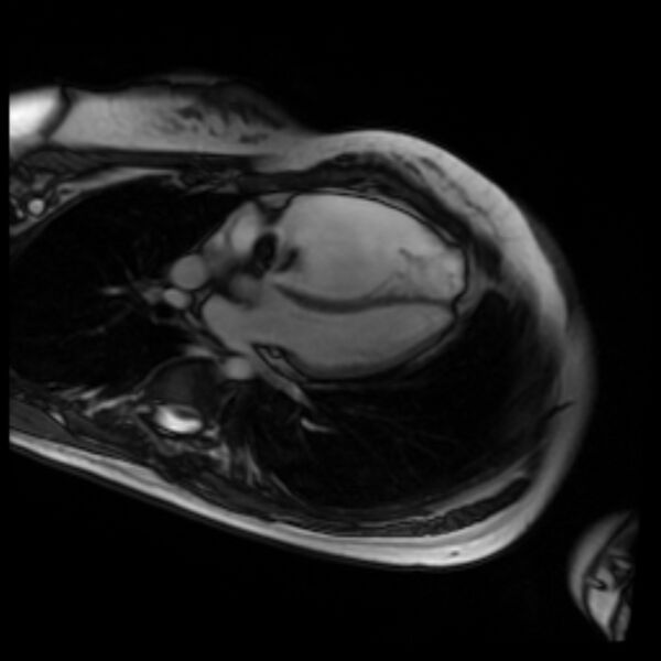 File:Arrhythmogenic right ventricular cardiomyopathy (Radiopaedia 87505-103850 4ch Cine SSFP 58).jpg