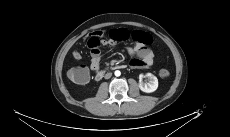 File:Arterial occlusive mesenteric ischemia (Radiopaedia 84641-100060 A 63).jpg