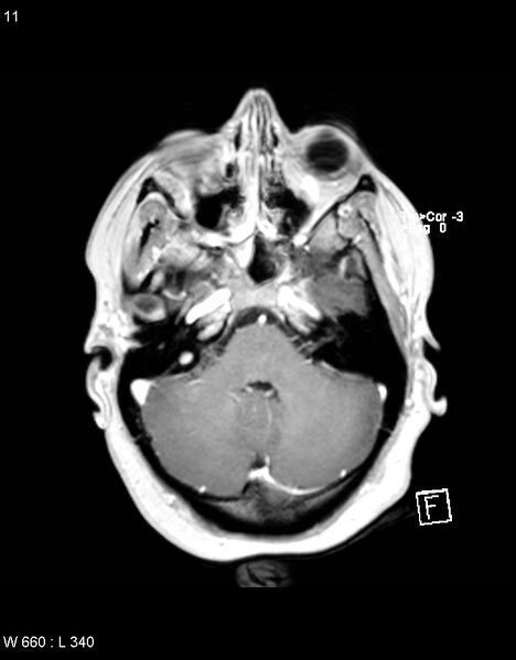 File:Astroblastoma (Radiopaedia 39792-42218 Axial T1 C+ 10).jpg