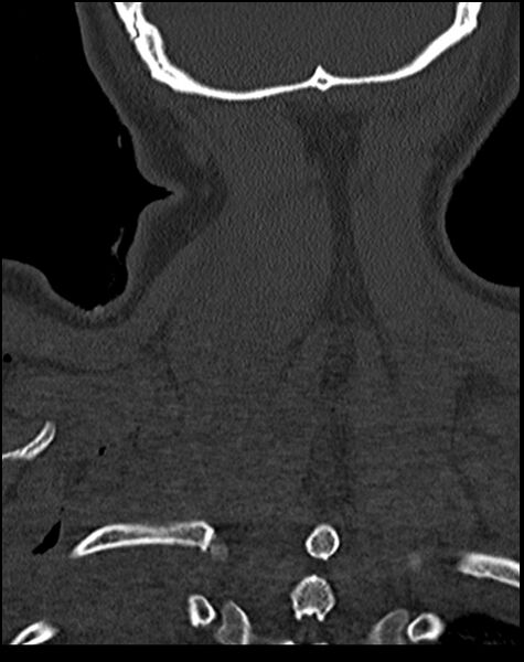 File:Atlanto-occipital dissociation - Traynelis type 1 (Radiopaedia 87570-103948 Coronal bone window 52).jpg