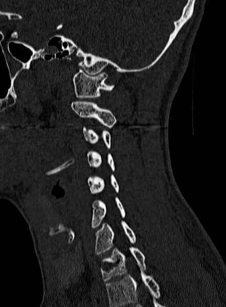 File:Atlantoaxial subluxation (Radiopaedia 44681-48450 Sagittal bone window 118).jpg
