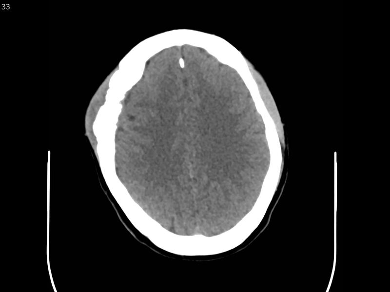 File:Atypical meningioma - intraosseous (Radiopaedia 64915-73867 A 33).jpg