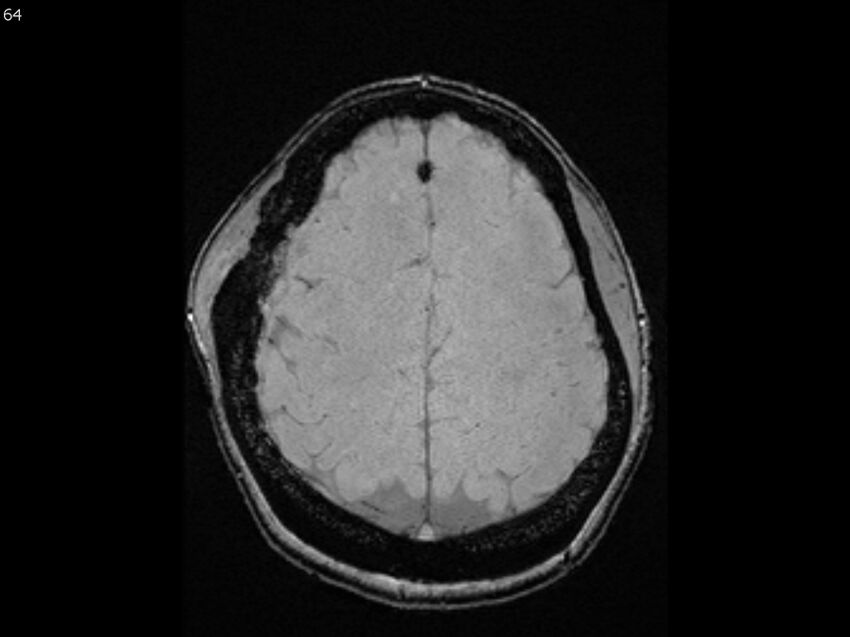 Atypical meningioma - intraosseous (Radiopaedia 64915-74572 Axial SWI 64).jpg