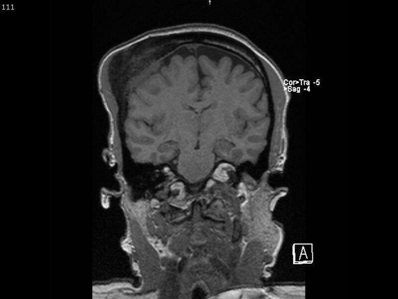 File:Atypical meningioma - intraosseous (Radiopaedia 64915-74572 Coronal T1 111).jpg