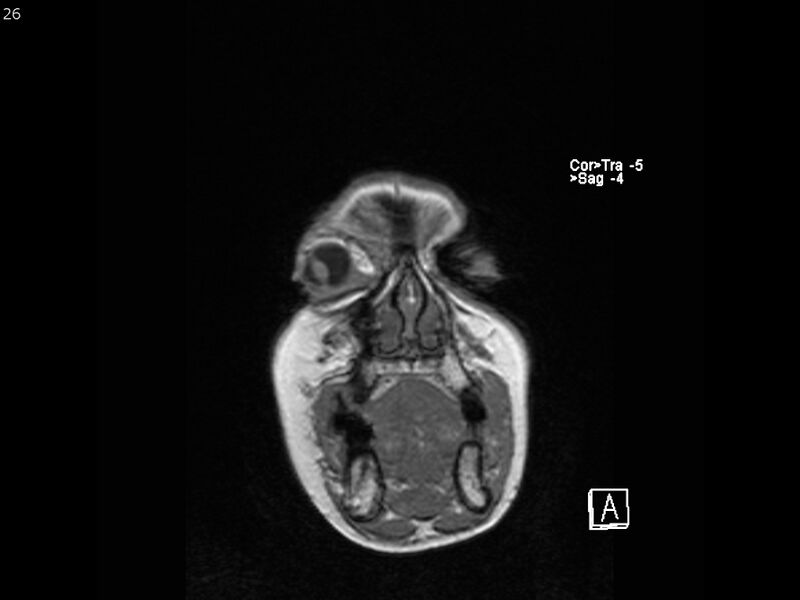 File:Atypical meningioma - intraosseous (Radiopaedia 64915-74572 Coronal T1 26).jpg