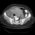 Atypical retroperitoneal lymphocoeles with large leiomyoma of uterus (Radiopaedia 32084-33024 A 28).jpg