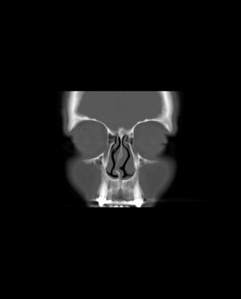 File:Automastoidectomy with labyrinthine fistula (Radiopaedia 84143-99411 Coronal non-contrast 11).jpg