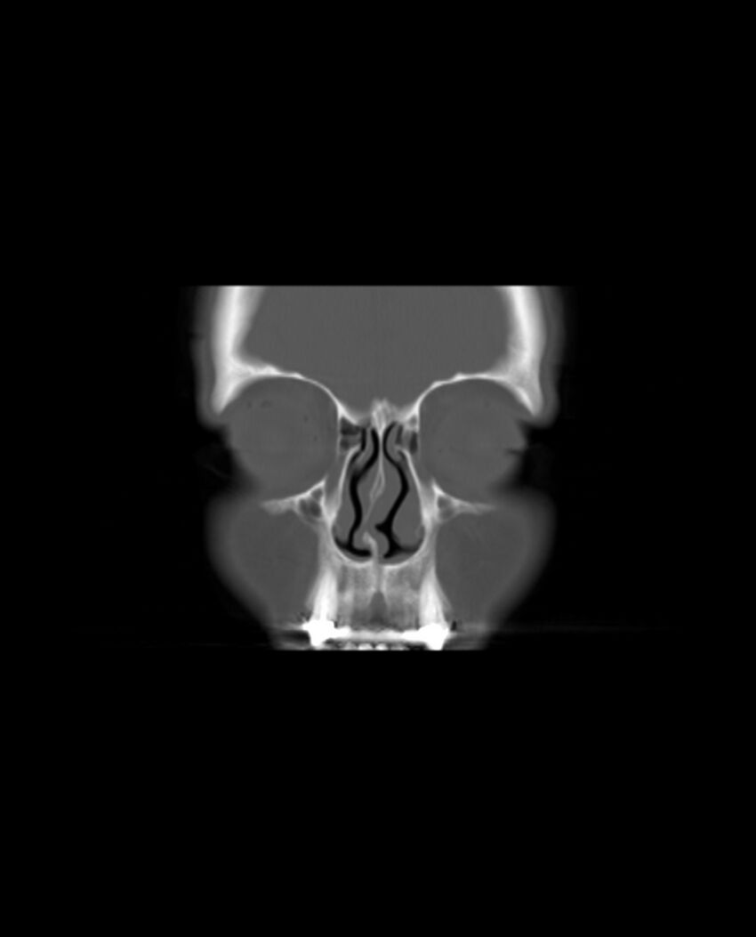 Automastoidectomy with labyrinthine fistula (Radiopaedia 84143-99411 Coronal non-contrast 11).jpg