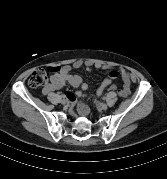 File:Autosomal dominant polycystic kidney disease (Radiopaedia 41918-44922 Axial non-contrast 26).jpg