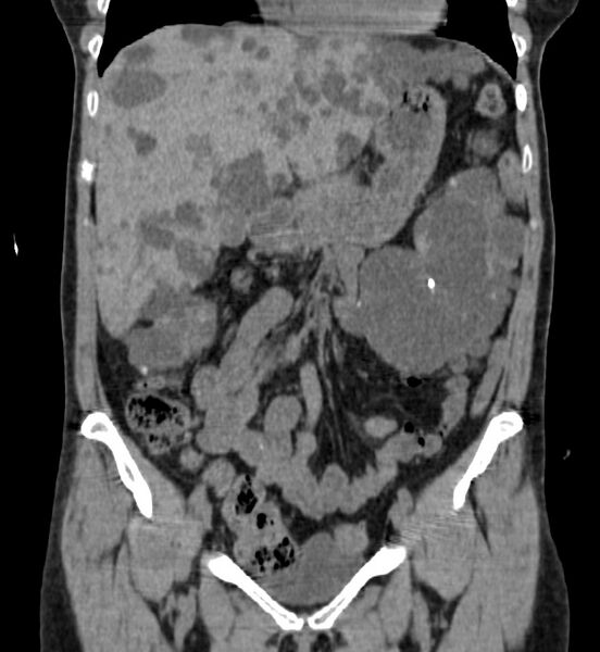 File:Autosomal dominant polycystic kidney disease (Radiopaedia 41918-44922 Coronal non-contrast 10).jpg