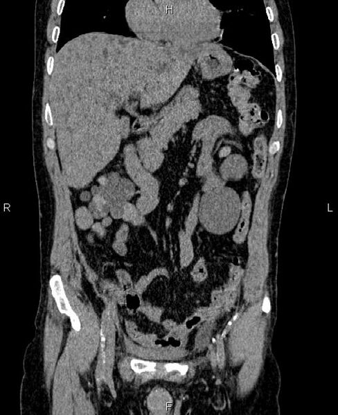 File:Autosomal dominant polycystic kidney disease (Radiopaedia 87830-104287 Coronal non-contrast 19).jpg