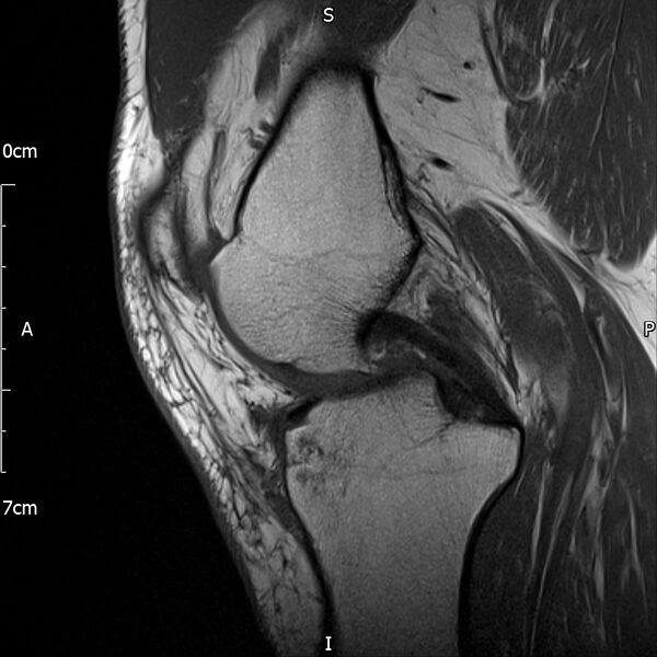 File:Avulsion fracture of the fibular head (Radiopaedia 74804-85808 D 15).jpg