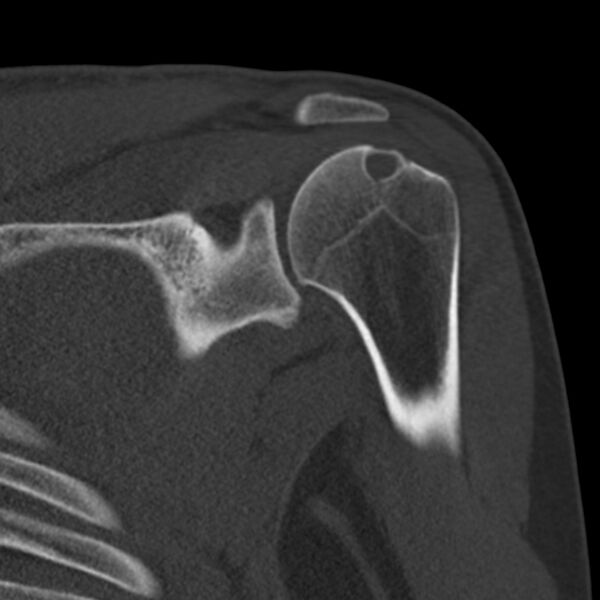 File:Bankart lesion (Radiopaedia 22771-22798 Coronal bone window 23).jpg